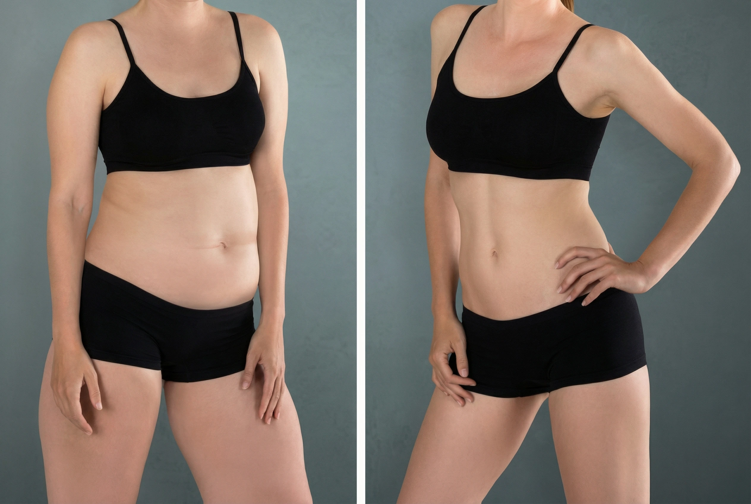 Female body sculpting before and after showing visible fat reduction and body contouring around midsection