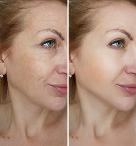 PRP facial treatment before and after results showing reduced fine lines and rejuvenated skin